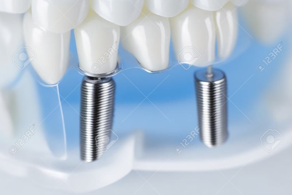 Implant dentaire orthodontique esthétique en titane dentaire chez les dentistes bouche modèle de dents closeup isolé.