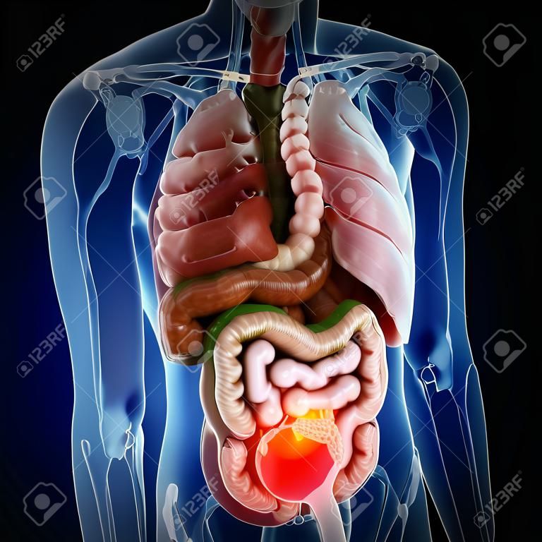 3d rendered medically accurate illustration of colon cancer
