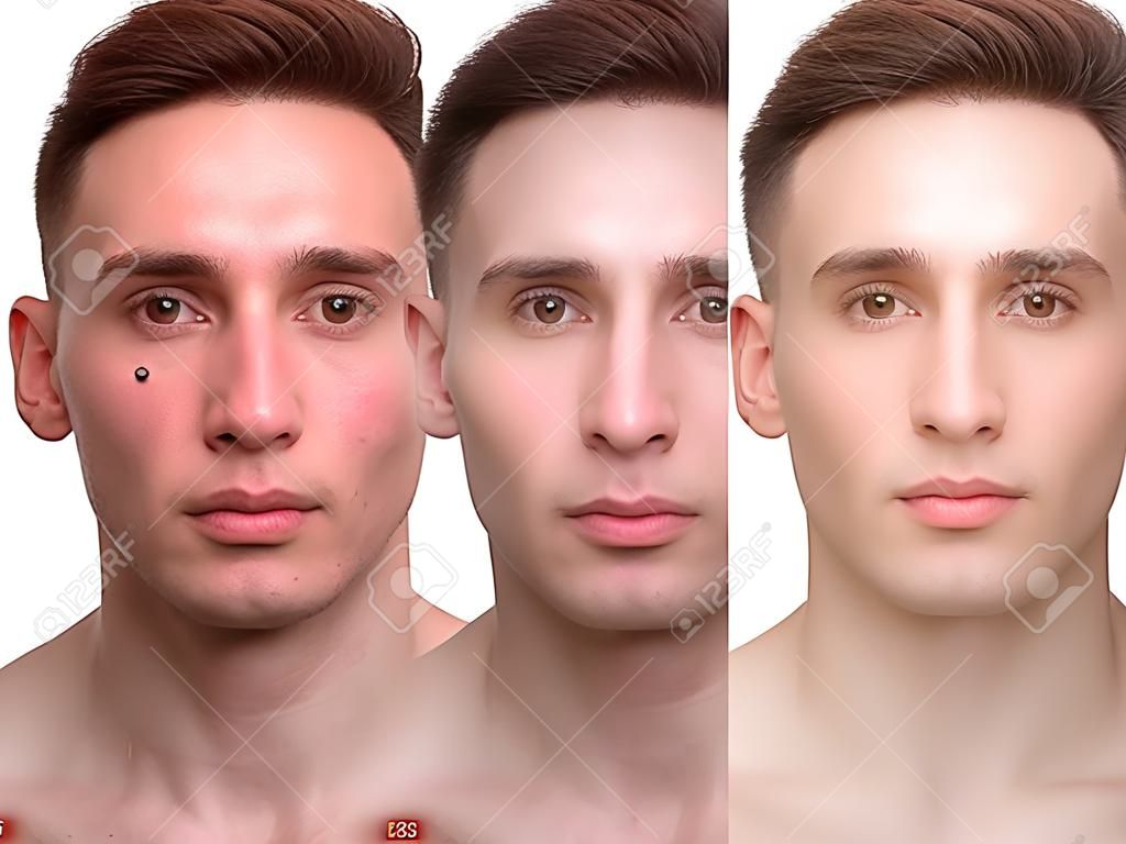 Gesicht der schönen Mann vor und nach der Retusche. Vor und nach der kosmetischen Operation. Anti-Aging-Therapie, die Entfernung von Akne, Retusche. Studio gedreht.