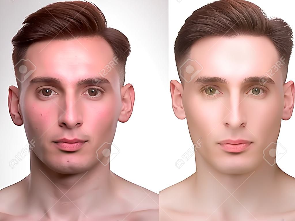 Gesicht der schönen Mann vor und nach der Retusche. Vor und nach der kosmetischen Operation. Anti-Aging-Therapie, die Entfernung von Akne, Retusche. Studio gedreht.