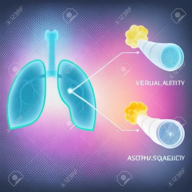 ilustracji wektorowych astma oskrzelowa, choroby układu oddechowego, płuc,