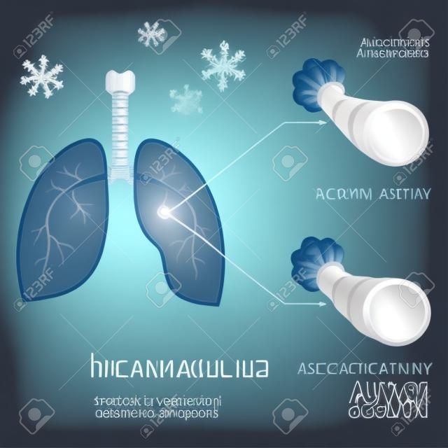 vektoros illusztráció asztma, bronchiális, légzőszervi betegségek a tüdő,