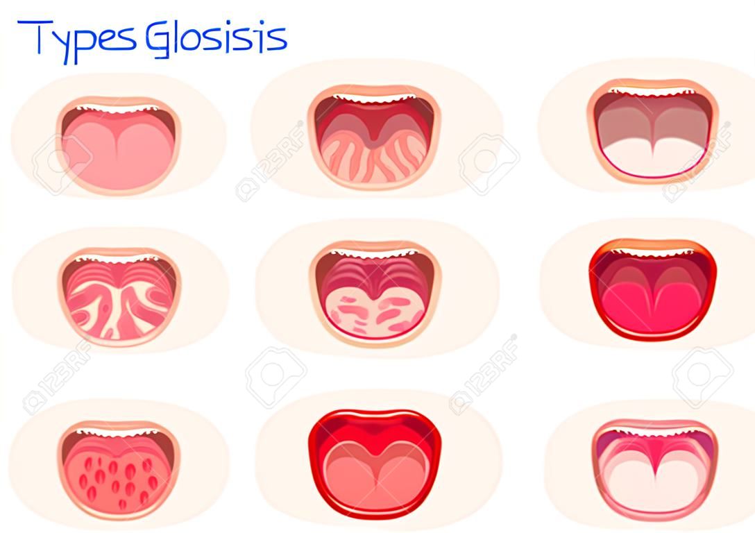 Typen Glossitis. Entzündungskrankheit Zunge, Vektorillustration