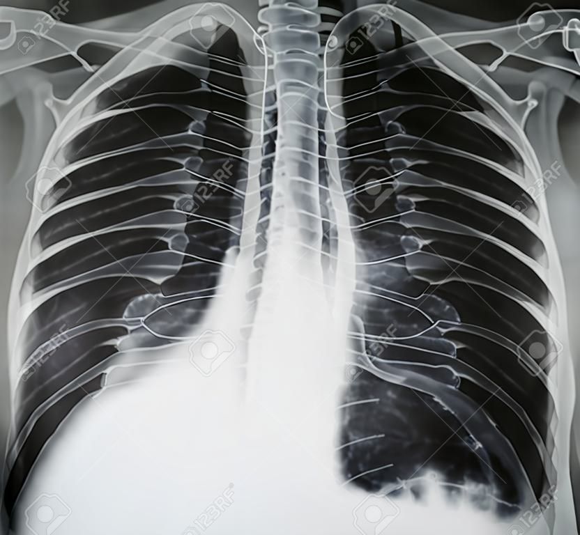 Radiografia del torace normale, polmoni sani normali, bianco e nero