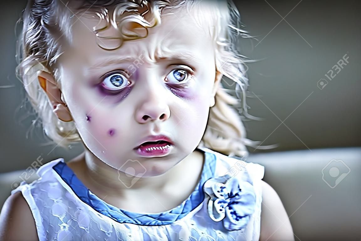 Sad and Frightened Little Girl with Bloodshot and Bruised Eyes.