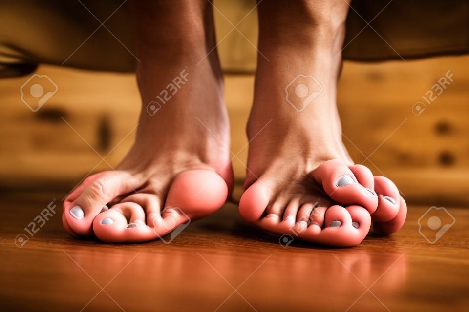 Pés descalços que têm problema de joanete (hallux valgus) no piso marrom de madeira. Deformação da articulação conectando o dedão do pé ao pé