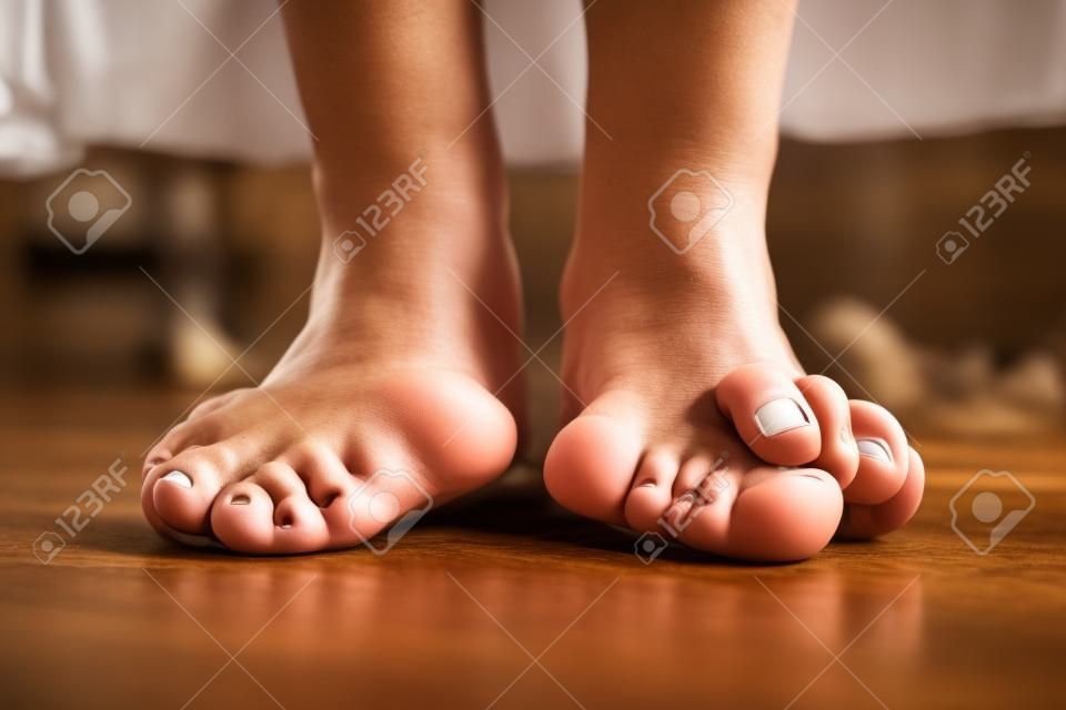 Pés descalços que têm problema de joanete (hallux valgus) no piso marrom de madeira. Deformação da articulação conectando o dedão do pé ao pé