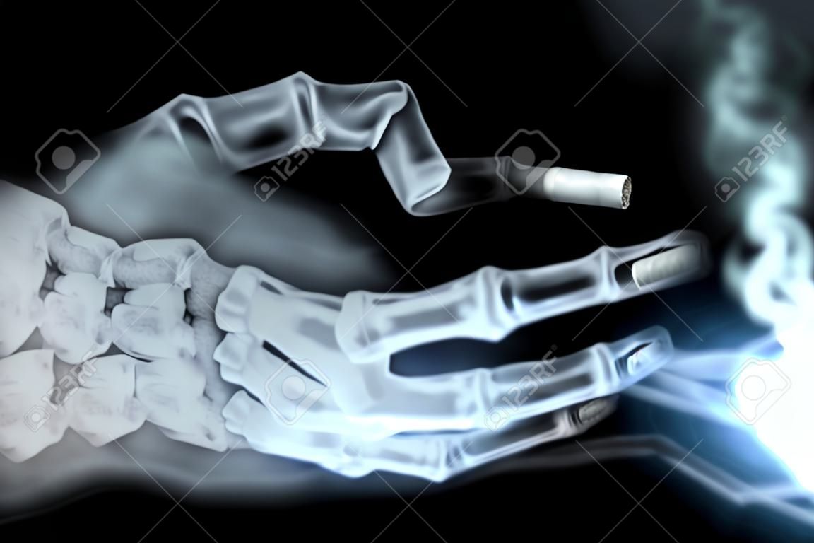 x-ray hand holding cigarette