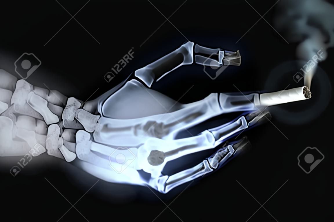 x-ray hand holding cigarette