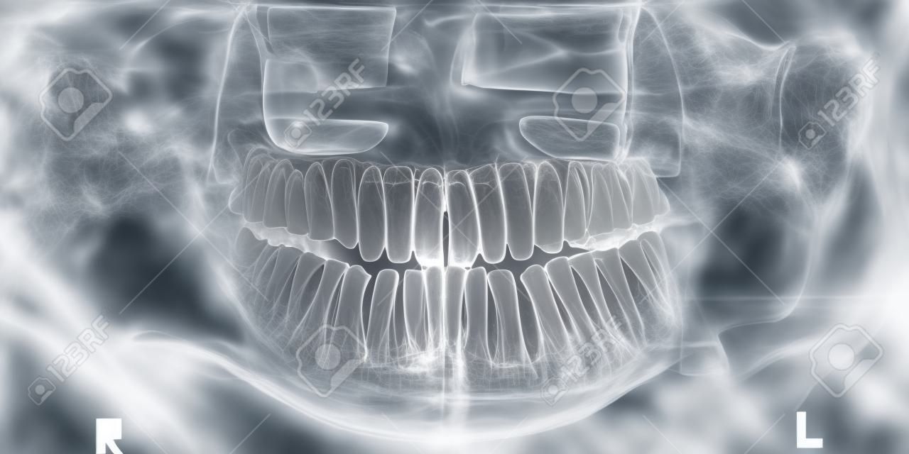 Imagem panorâmica de raios-x de dentes. Problema com dente do siso.