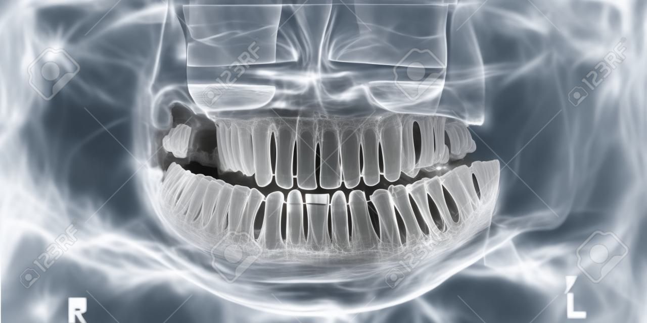 Imagem panorâmica de raios-x de dentes. Problema com dente do siso.