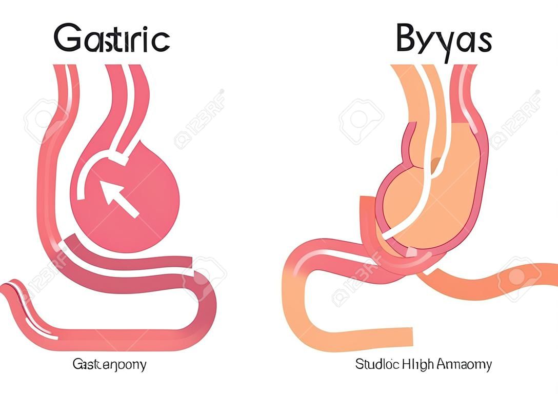 Gastric Bypass vector / maag anatomie