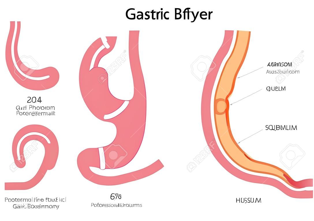 Gastric Bypass vector / maag anatomie