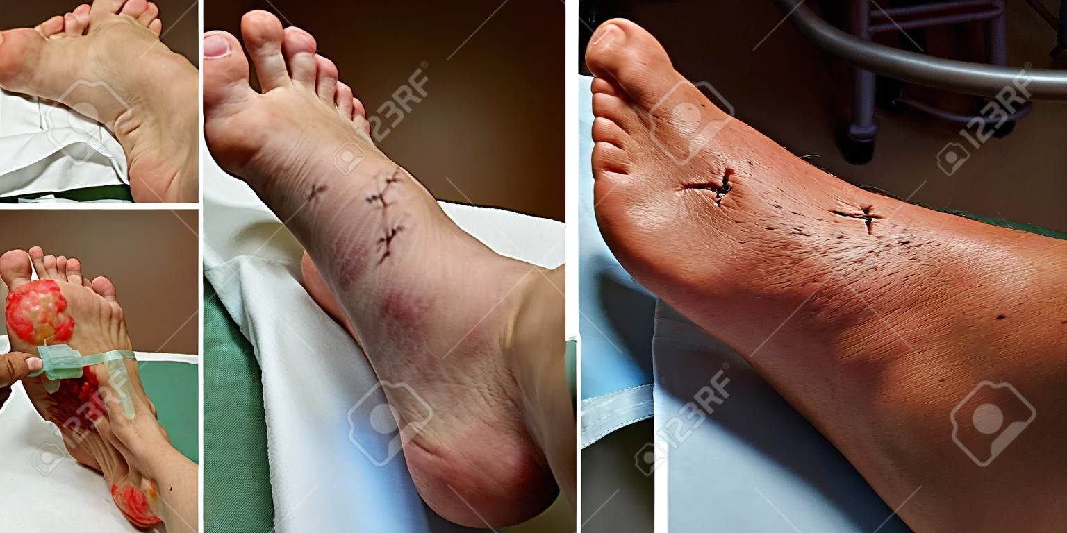 开放性关节脱位踝关节-手术和手术前受伤。