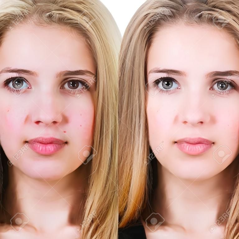 retrato de la comparación de la joven con la piel problemática antes y después del tratamiento