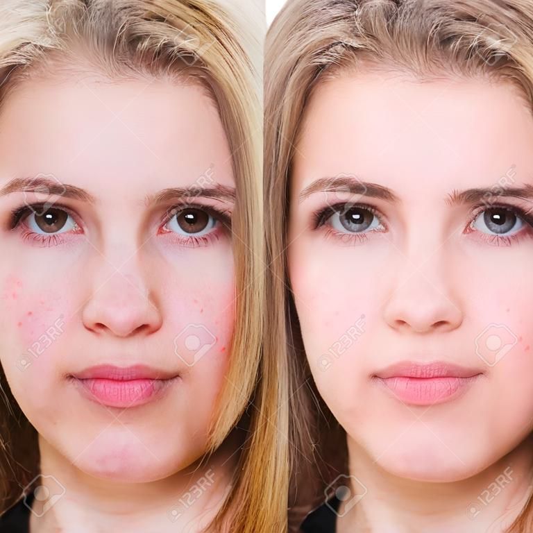 Retrato de comparação de menina com pele problemática antes e depois do tratamento
