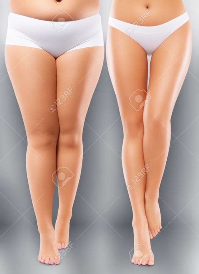 Woman legs before and after slimming.