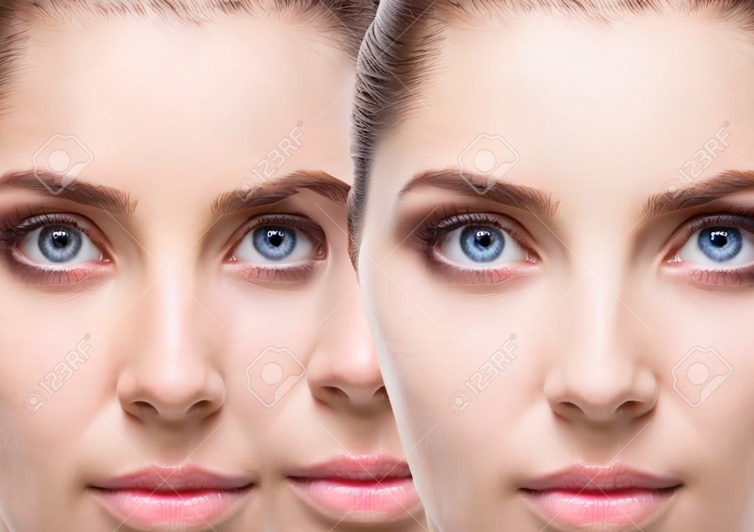 Vrouwelijke ogen met blauwe plekken onder de ogen voor en na cosmetische behandeling.