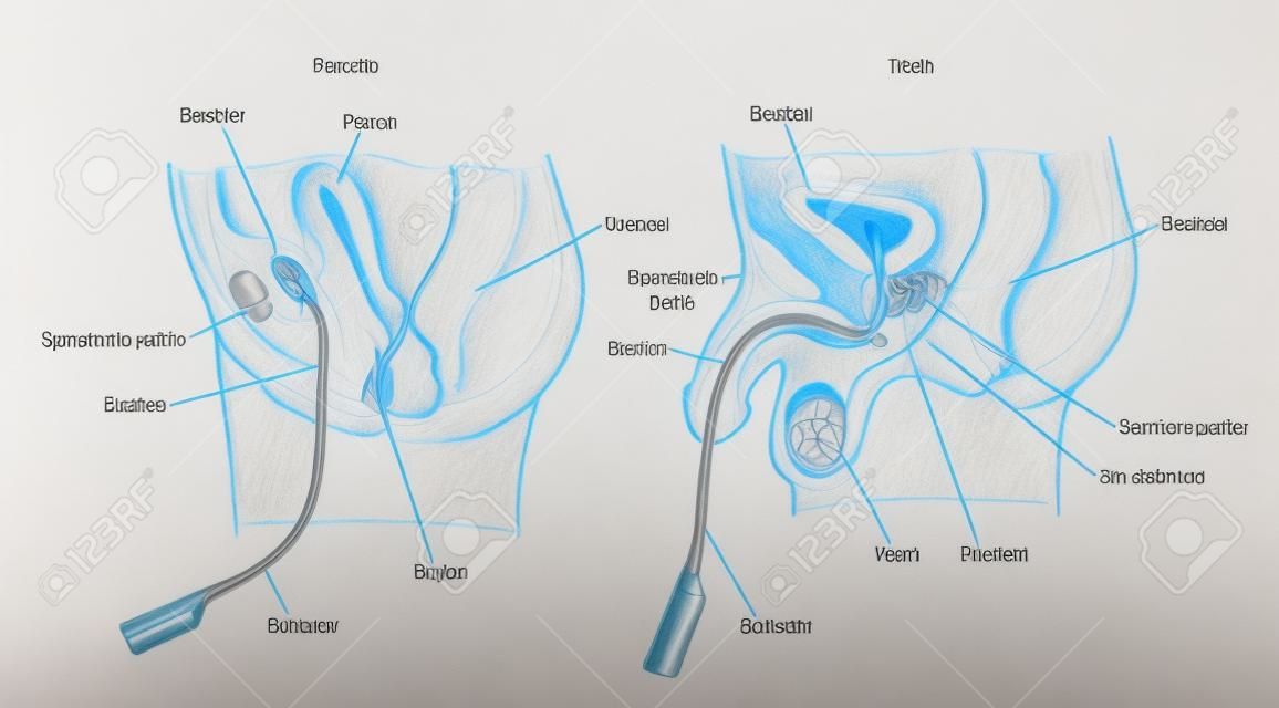 Drawing to show a urinary catheter placed in the female bladder and the male bladder via the urethra
