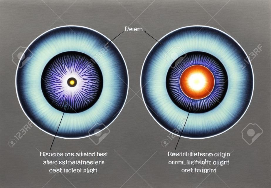 Dibujo para mostrar los músculos circulares del iris y de los músculos radiales del iris utilizados en el control de la luz en el ojo