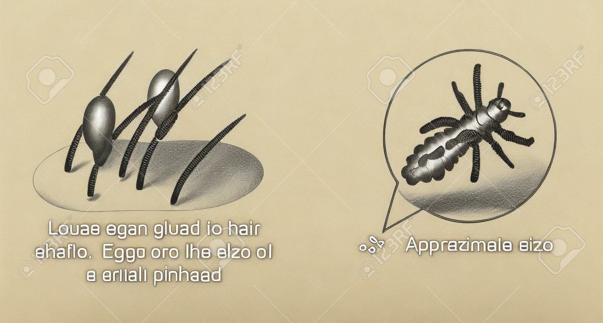 図面の頭の寄生虫の卵が毛シャフトと頭シラミの拡大された図面に接着