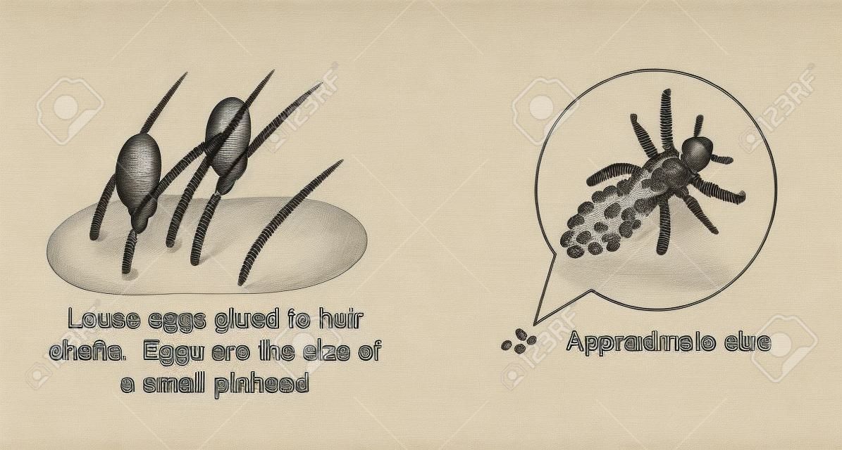 Disegno di uova di pidocchio testa incollata al fusto del capello e un disegno ingrandita di un pidocchio del capo