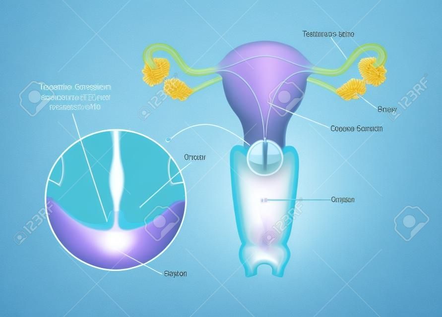 Zona de transformación del cuello uterino.