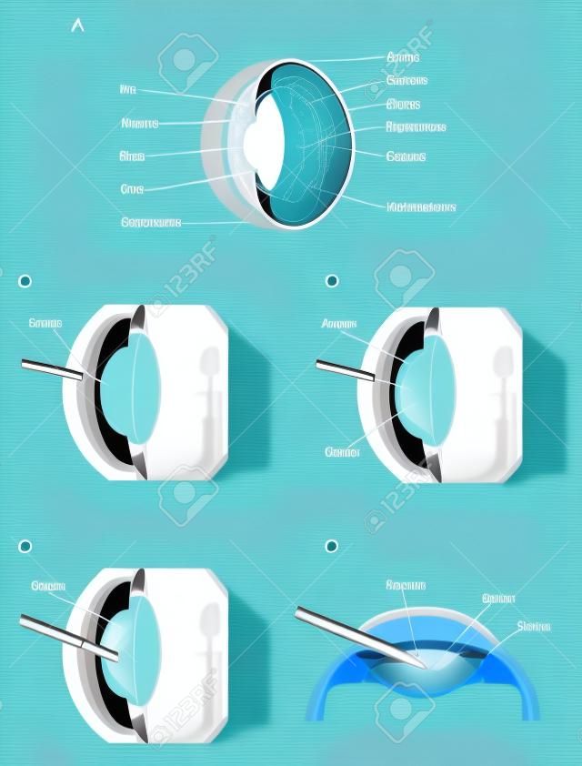 Операции катаракты, показывая нормальный глаз и объектив с катарактой. Процедура хирургического удаления показан. Созданный в Adobe Illustrator. Содержит прозрачные и градиент сетки. EPS 10.