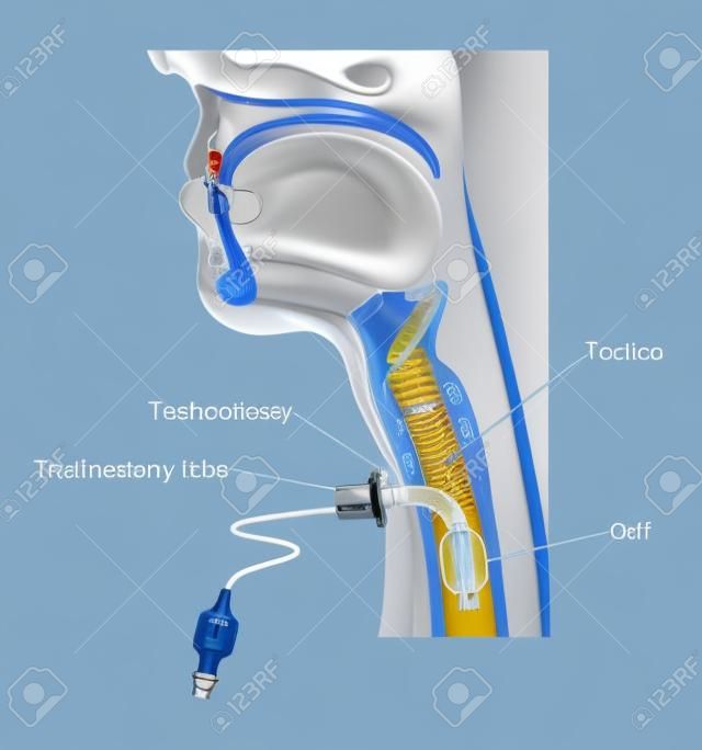 Tubo tracheostomia in situ, mostrando la posizione della cannula esterna e il polsino gonfiato all'interno della trachea.
