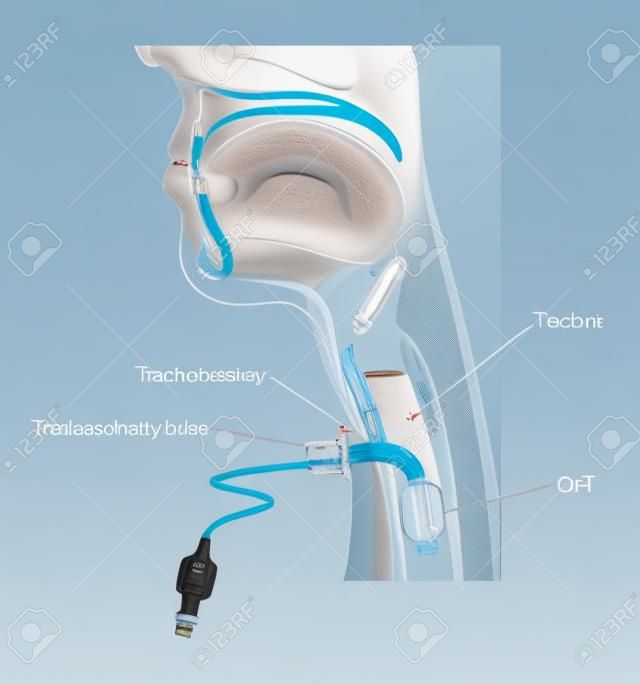 Tracheostomy tube in-situ, 외측 캐뉼라의 위치와 기관 내부의 팽창 된 커프스 위치.