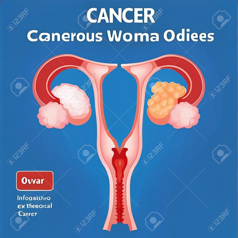 An informative infographic illustrating the differences between normal and cancerous ovaries in women