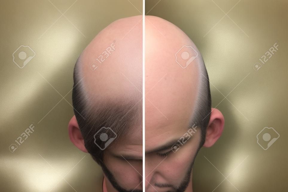 Cabello de hombres después de usar polvo cosmético para engrosar el cabello. Corona con cabeza calva. Antes y después de.