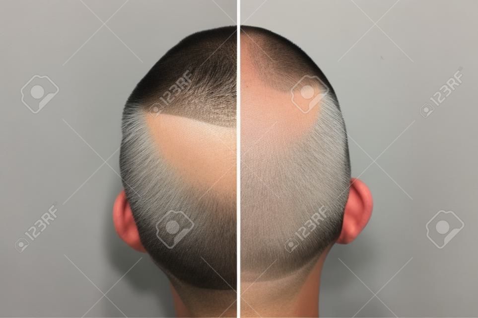 Männerhaar nach der Verwendung von kosmetischem Puder zur Haarverdickung. Krone mit Glatze. Vorher und nachher.