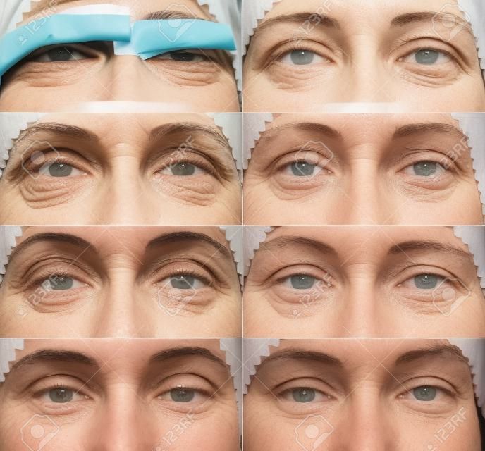 Blepharoplasty of the upper eyelid. The photo shows the progress of healing of the scar and recovery of the patient. Open eyes on the first, third, fifth, ninth, eleventh day, the first and second month after the operation.