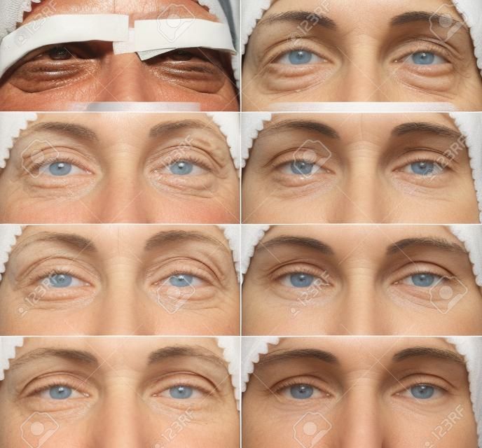 Blepharoplastik des oberen Augenlids. Das Foto zeigt den Fortschritt der Heilung der Narbe und die Genesung des Patienten. Öffnen Sie die Augen am ersten, dritten, fünften, neunten, elften Tag, dem ersten und zweiten Monat nach der Operation.