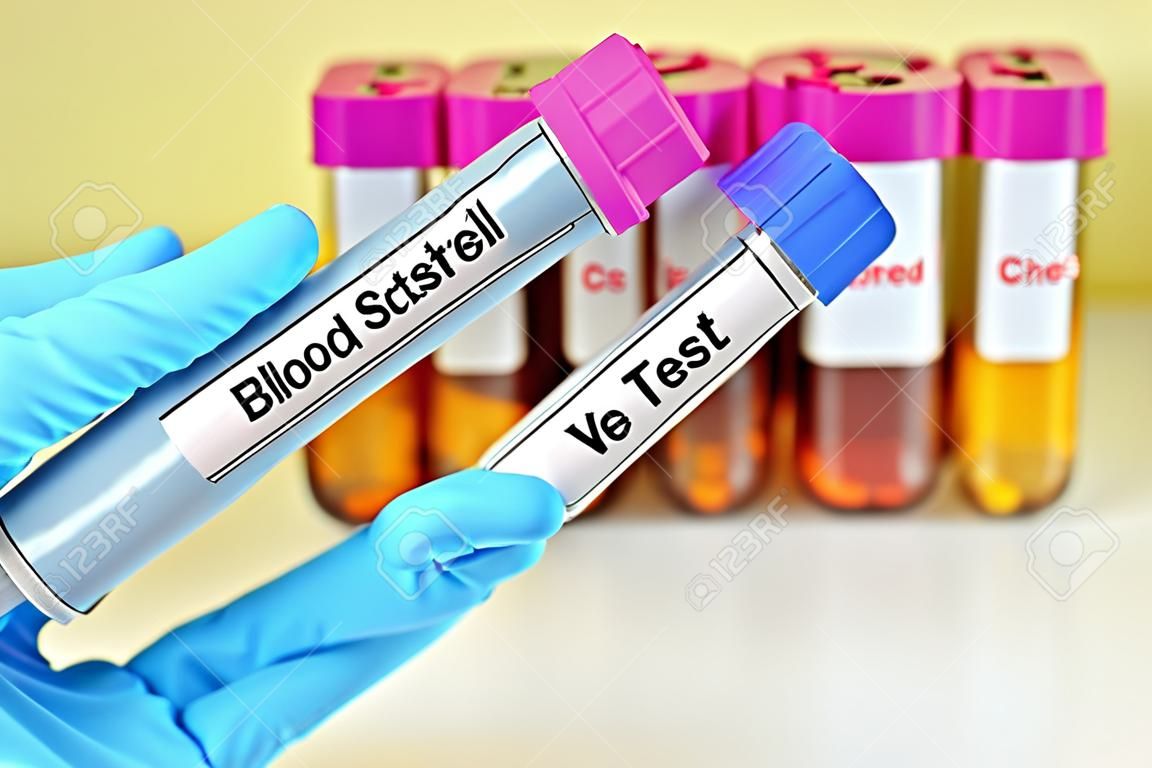 Próbka krwi do testu cholesterolu