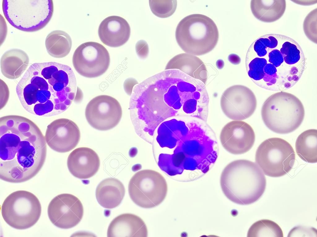 Les globules blancs dans frottis de sang périphérique