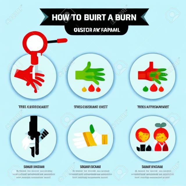 How to treat a burn info-graphic. Vector illustration.