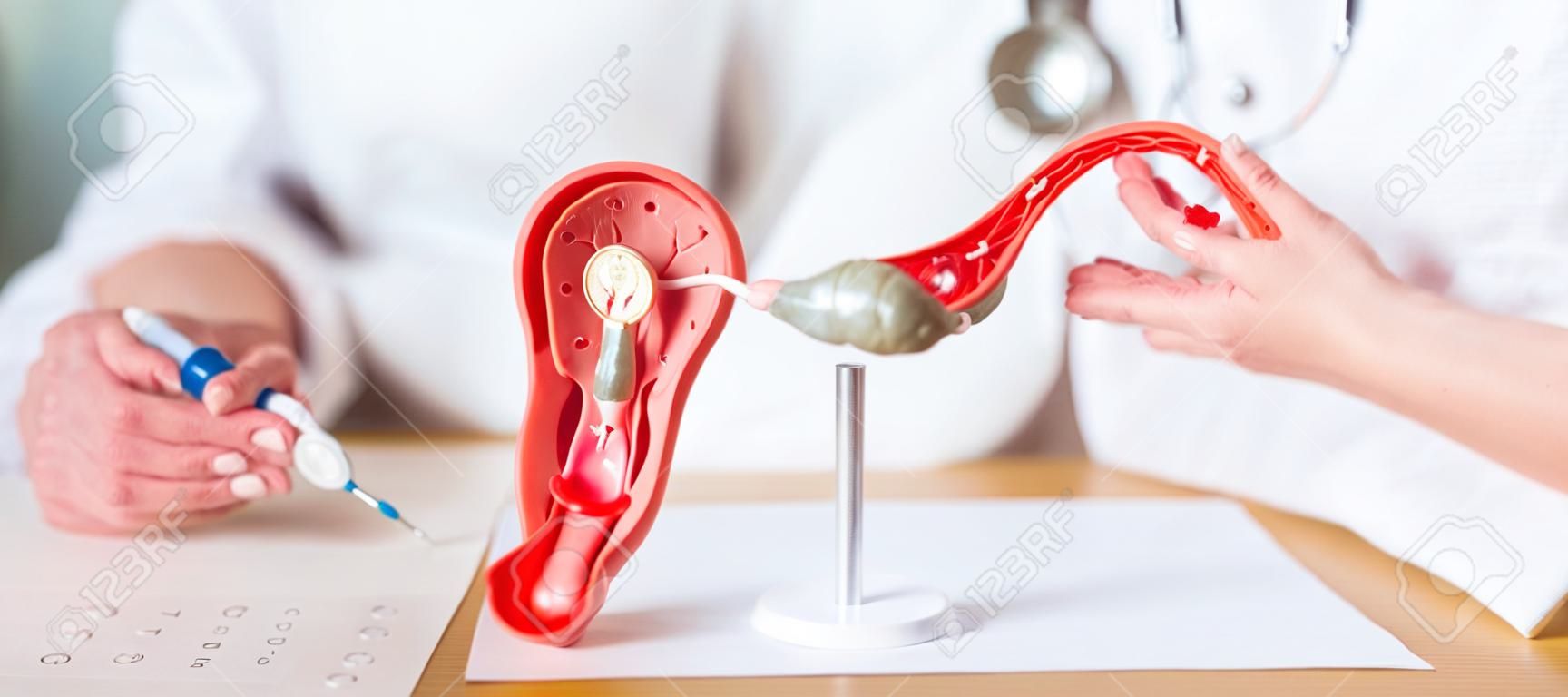 Médico con útero y ovarios modelo de anatomía cáncer de ovario y cuello uterino trastorno del cuello uterino endometriosis histerectomía fibromas uterinos sistema reproductivo embarazo y concepto de salud