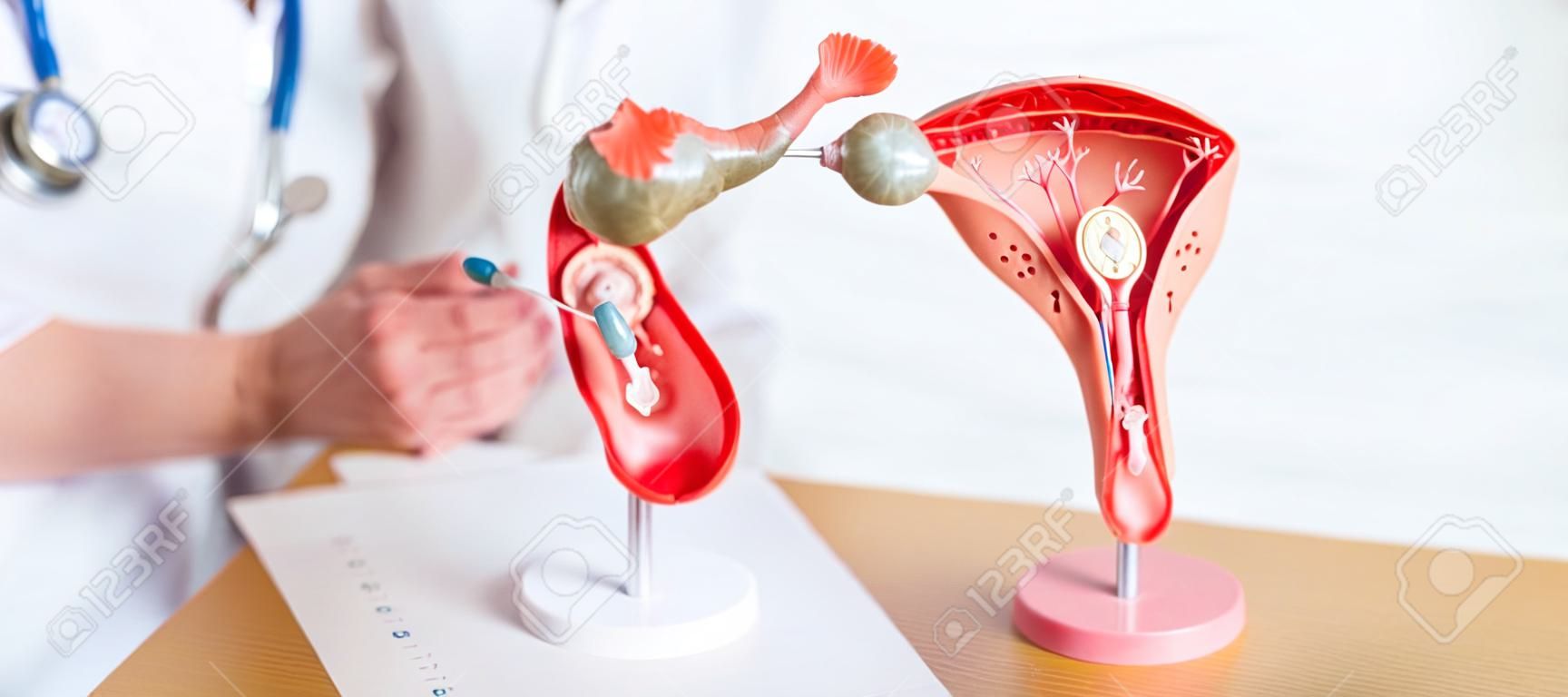 Lekarz z macicą i jajnikami model anatomiczny rak jajnika i szyjki macicy zaburzenie szyjki macicy endometrioza histerektomia mięśniaki macicy układ rozrodczy koncepcja ciąży i zdrowia