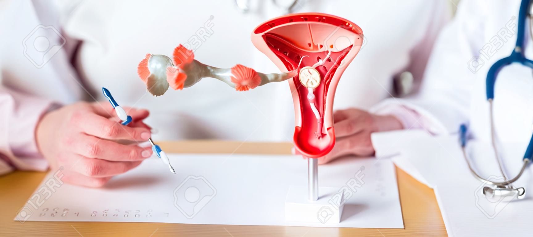 Médico con útero y ovarios modelo de anatomía cáncer de ovario y cuello uterino trastorno del cuello uterino endometriosis histerectomía fibromas uterinos sistema reproductivo embarazo y concepto de salud