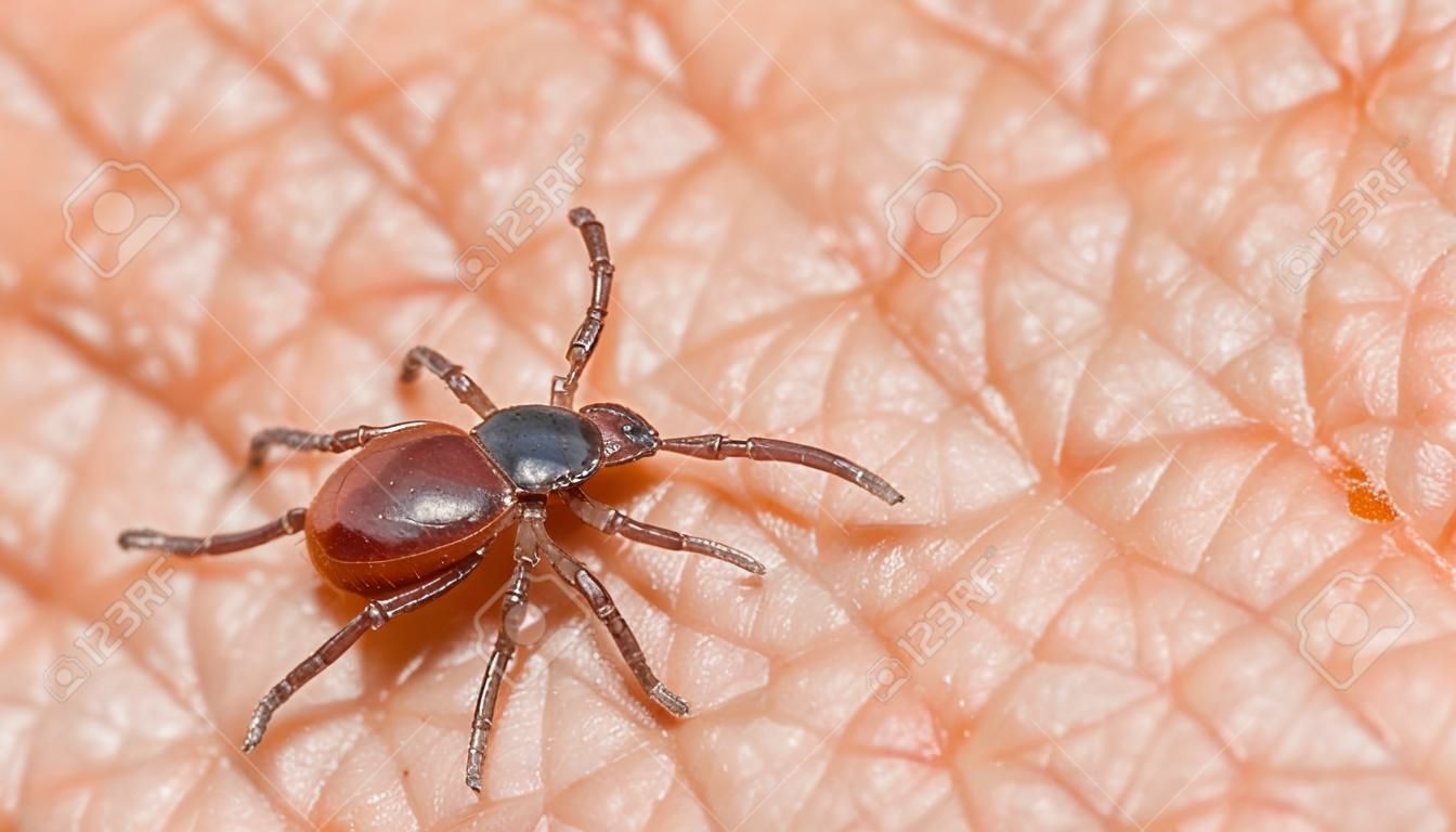 Closeup of female deer tick parasite on human skin background. Ixodes ricinus. Parasitic insect mite on pink epidermis. Carrier of tick-borne diseases as encephalitis or babesiosis