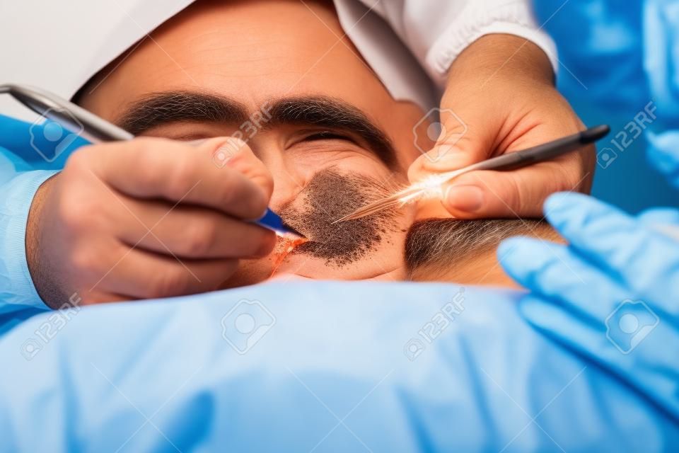 Close-up surgeon burns a mole on the back of the patient. Mole Removal Surgery Procedure.