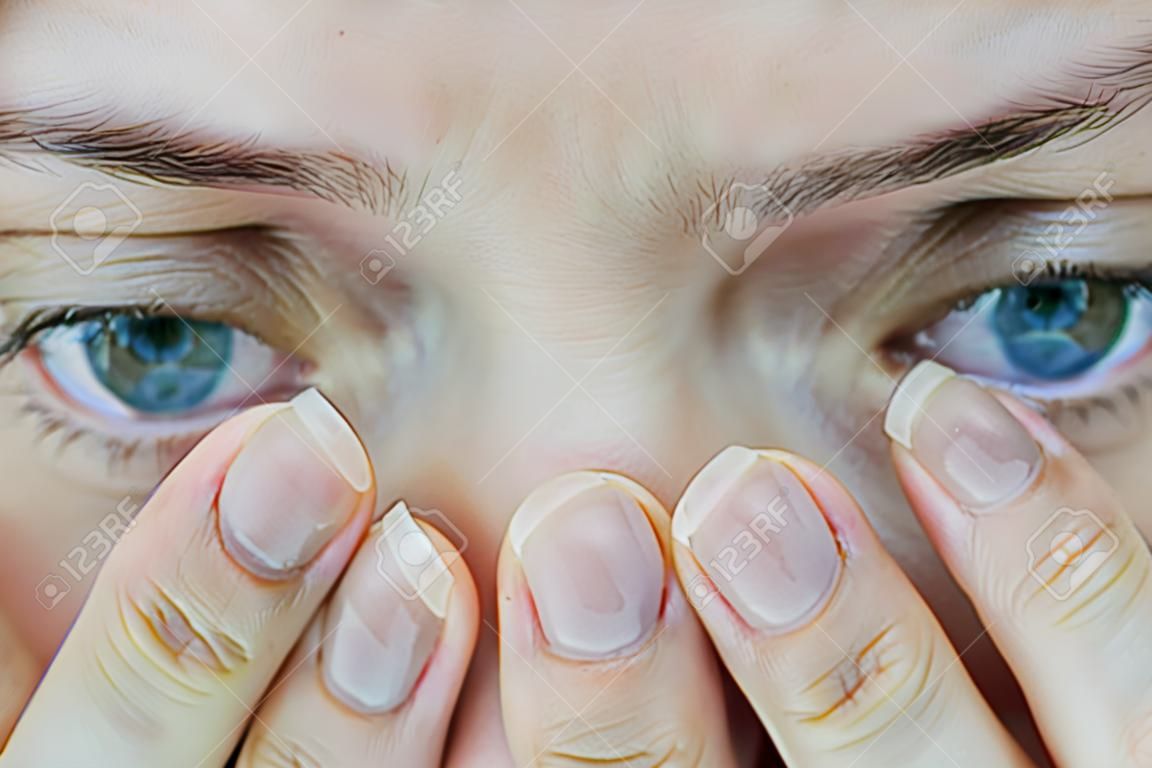 middle aged female's eye with drooping eyelid. Ptosis is a drooping of the upper eyelid, lazy eye. Cosmetology and facial concept, first wrinkles, closeup
