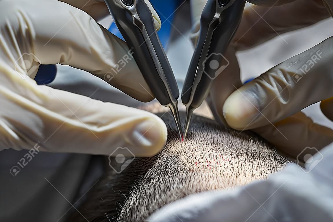 Hair transplantation process, pulling hair follicles back and replanting them.