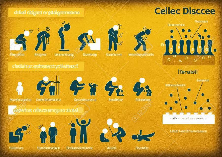 Celiac disease signs and symptoms. Illustrations depict celiac disease problems in adult and children.