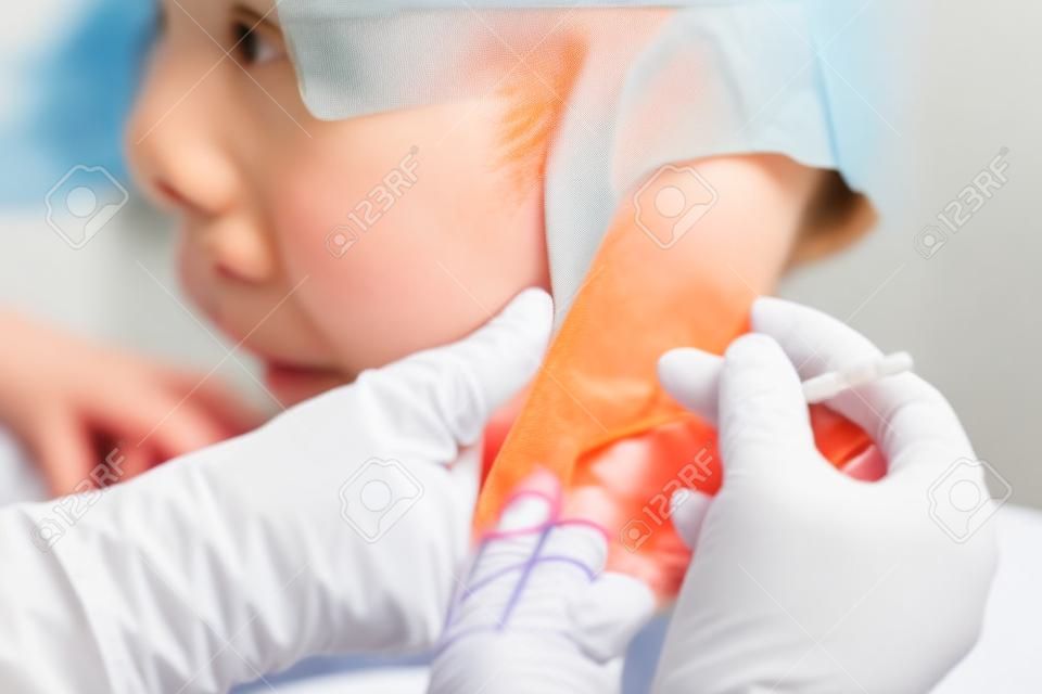 Allergen test on hand. child undergoing procedure of allergen skin test in clinic.
