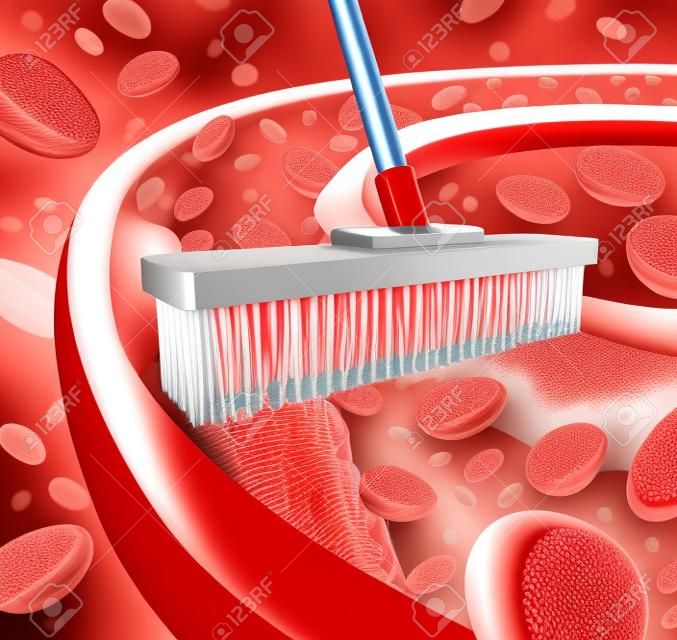 Cleaning arteries concept as a broom removing plaque buildup in a clogged artery as a symbol of  atherosclerosis disease medical treatment opening clogged veins with blood cells as a metaphor for removing cholesterol as an icon of vascular diseases 