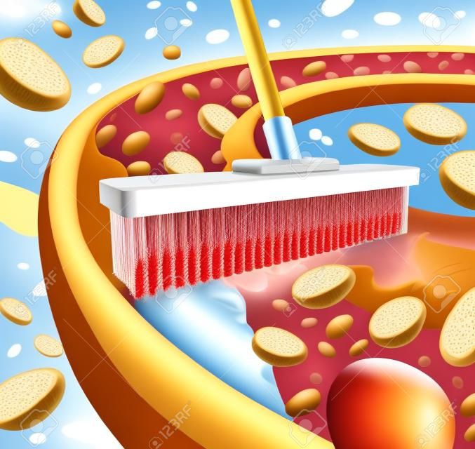 Reinigungs Arterien Konzept wie einem Besen entfernen Plaque-Bildung in einer verstopften Arterie als Symbol der Atherosklerose Krankheit ärztliche Behandlung Öffnung verstopfte Adern mit Blutzellen als Metapher für die Entfernung von Cholesterin als Symbol von Gefäßerkrankungen