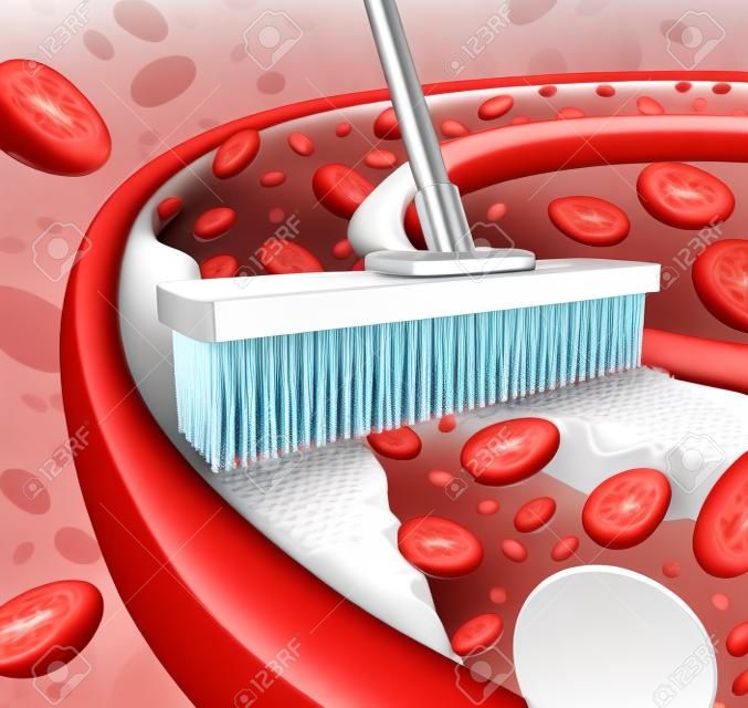 Vasküler hastalıkların bir simge olarak kolesterolü çıkarmak için bir metafor olarak ateroskleroz hastalığı tıbbi tedavi açılması bir sembolü olarak bir tıkanık damarın bir süpürge kaldırma plak birikimini gibi kan hücreleri ile tıkanmış damarları arterleri kavramını Temizlik